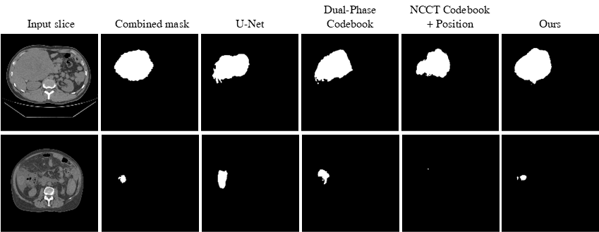 Qualitative comparison of NCCT liver lesion segmentation on representative test slices. From left to right: NCCT input, combined lesion annotation, direct NCCT training on UNet, Dual-Phase Codebook, NCCT Codebook + Position, and the pro- posed method.